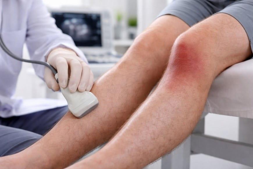 Bacağa Pıhtı Atması İyileşme Süresi