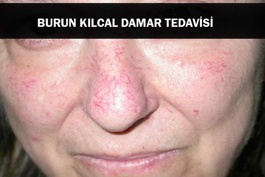 Burun Kılcal Damar Tedavisi