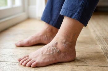 Ayak Damarların Şişmesi