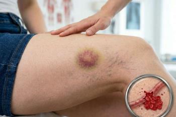 Damar Patlarsa Ne Olur?