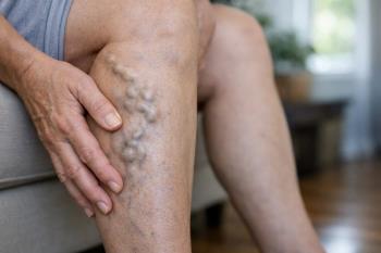 Damar Şişmesi Nedir?