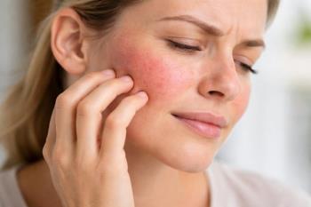 Gül Hastalığı Kaşıntı Yapar mı?