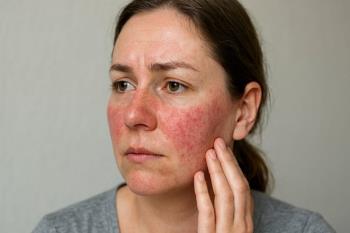 Gül Hastalığı Neden Olur?