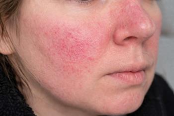 Roza Hastalığı Nasıl Geçer?