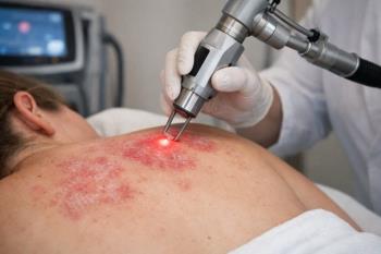 Vücutta Gül Hastalığı Nasıl Geçer?