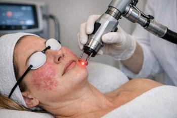 Yüzde Gül Hastalığı Nasıl Geçer?