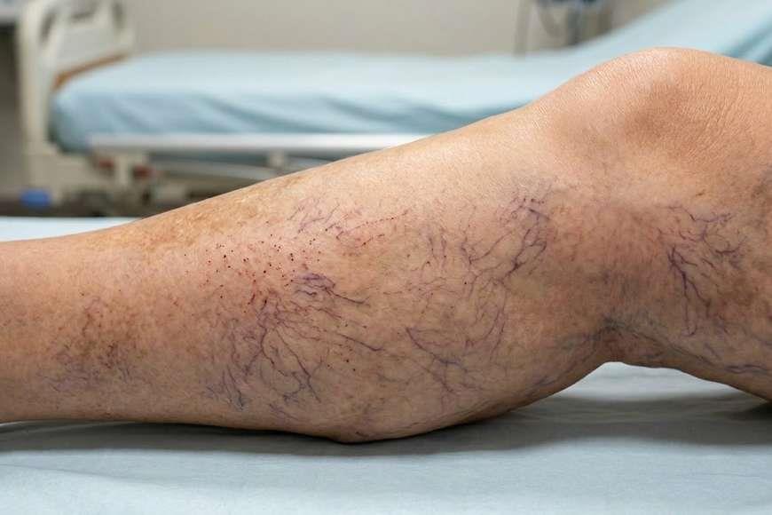 Kılcal Damar Kanaması Nasıl Olur?