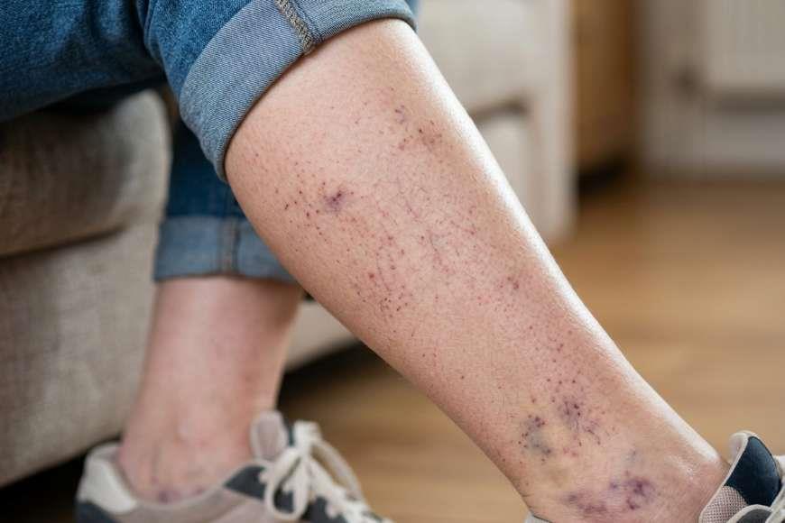 Kılcal Damar Patlaması Belirtileri