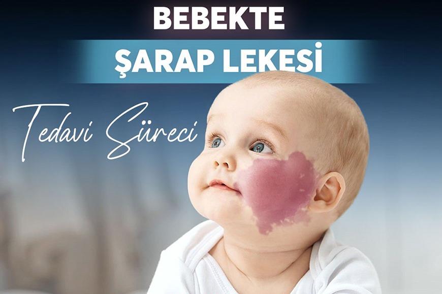 Bebeklerde Porto Şarabı Lekesi Nedir?