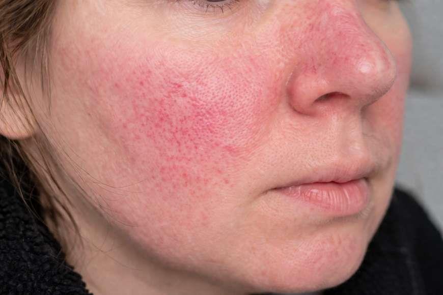 Roza Hastalığı Nasıl Geçer?