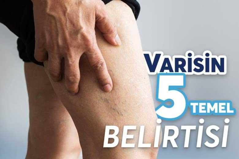 Varisin 5 Temel Belirtisi